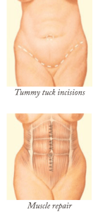A standard abdominoplasty