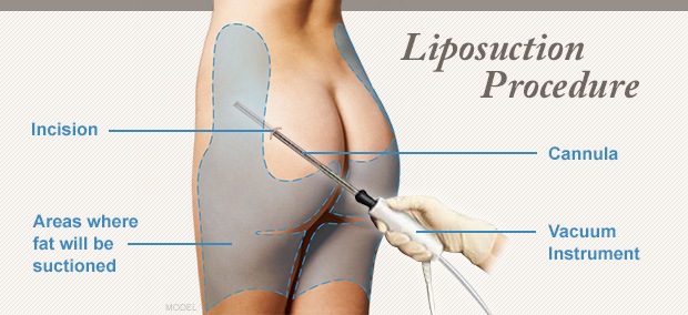 Liposuction procedure diagram